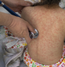 Nueva York declaró el estado de emergencia sanitaria por brote de casos de sarampión