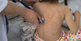 Nueva York declaró el estado de emergencia sanitaria por brote de casos de sarampión